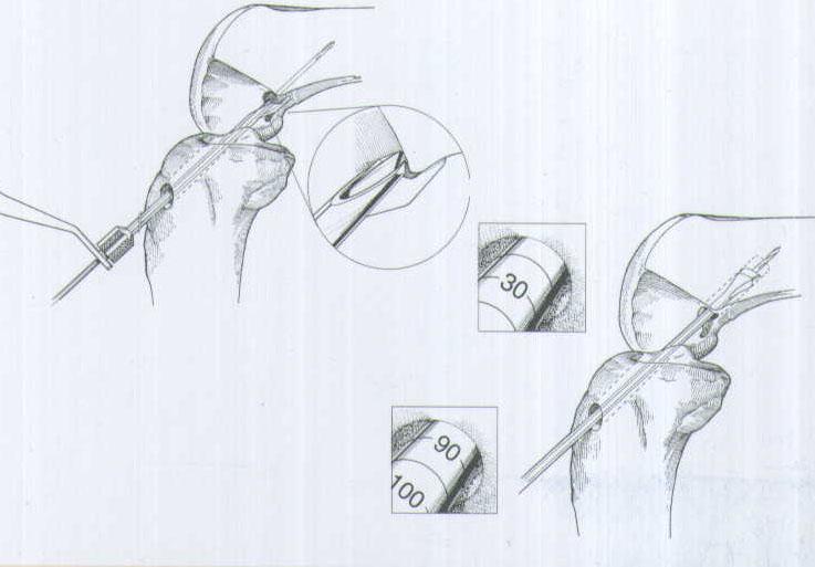 肌腱韌帶固定系統(tǒng)注冊技術審查指導原則(2020年第36號)(圖1) 肌腱韌帶固定系統(tǒng)注冊技術審查指導原則(2020年第36號)(圖1)